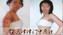 牛皮癣长全身 感谢津门皮肤病医院来拯救