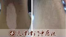 颈部白癜风4年，三个疗程全消失