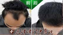 治好脱发，可以去拍婚纱照了
